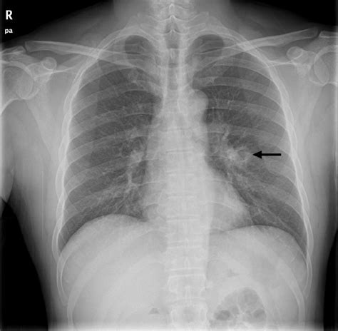 Chest Radiography Reveals A Cavitary Lesion Arrow In The Left Lung