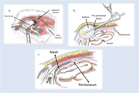 Laparoscopic Inguinal Hernia Surgery Anatomy