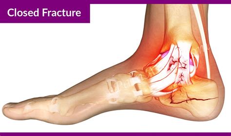 Calcaneus Fracture Or Broken Heel Treatment Recovery Symptoms Types