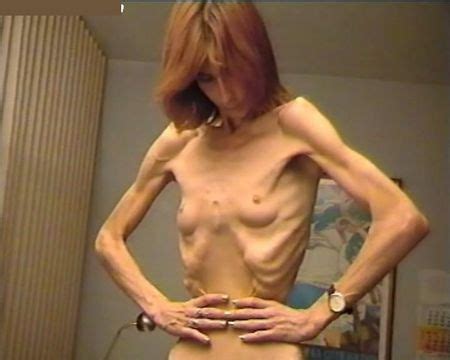 Anorexia Horrific Body Most Skinny Girls Page