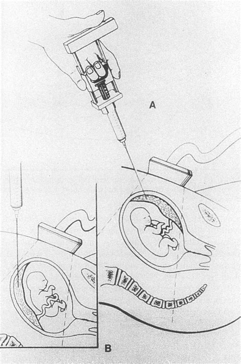The Drawing Shows The Transabdominal Chorionic Villus Sampling
