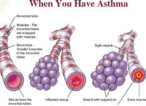 Destructive panbronchitis (entire bronchial wall envolved). Main Causes of Asthma - AirBetter.org