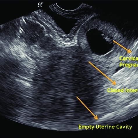 Early Cervical Ectopic Pregnancy With Embryonic Pole Transvaginal