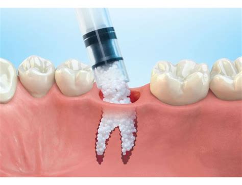 Bone Grafting Dental Implants Confident Smile Dental