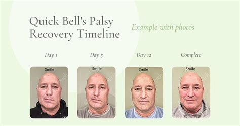 Quick Bell S Palsy Recovery With Photos Crystal Touch Bell S Palsy