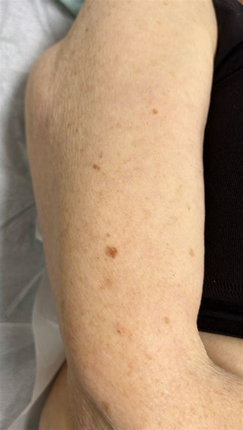 How To Recognise Skin Cancer On Your Arms What To Look For