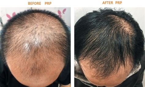 Is Prp For Hair Loss Effective