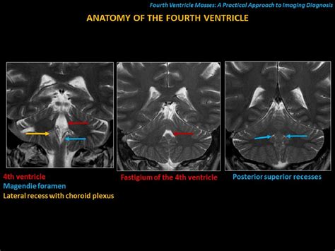 Fourth Ventricle Masses A Practical Approach To Imaging Diagnosis