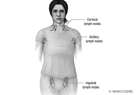 Lymphedema Diagnosis And Treatment Mayo Clinic