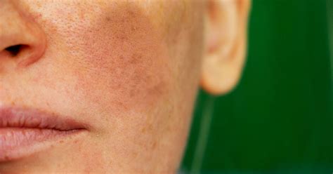 Melasma Treatments And Causes How To Get Rid Of Melasma