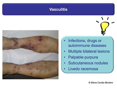 Necrosis And Purple Edges In Leg Ulcers Keys To Guide Your Diagnosis