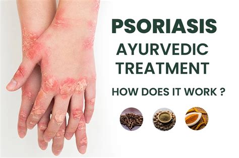 Psoriasis Ayurvedic Treatment And How Does It Work