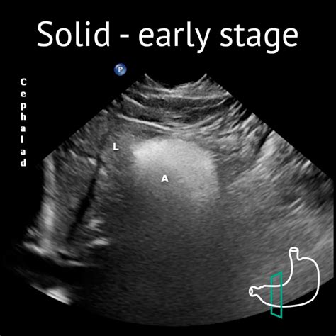 Gastric Ultrasound Image Gallery