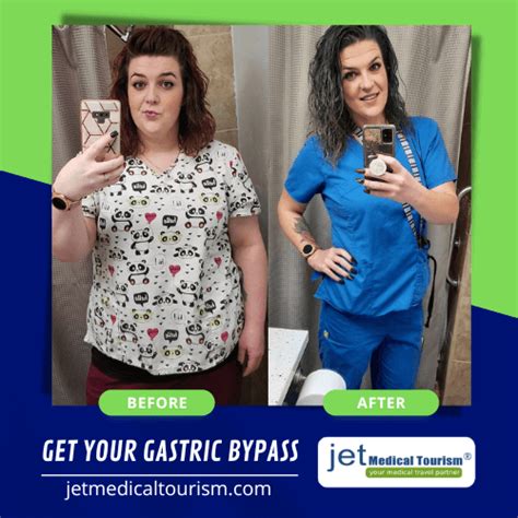 Gastric Bypass Weight Loss Chart Timeline Jet Medical Tourism®