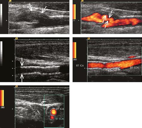 Figure Carotid Ultrasonography A B Mode Longitudinal Image
