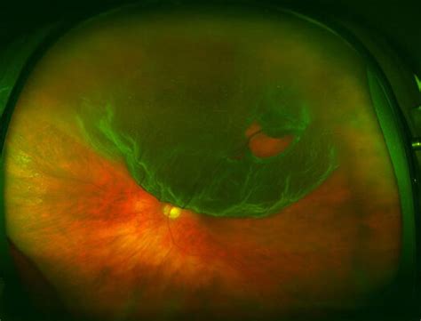 Retinal Detachment Surgery Nyc Eye Doctors Professional Community Article By Vitreous Retina