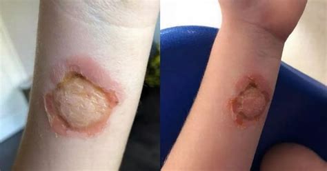 Girl Bitten By False Widow Spider As Sightings Increase Across South