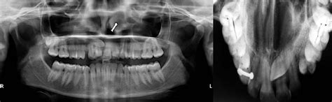 Unusual Intraosseous Transmigration Of Impacted Tooth