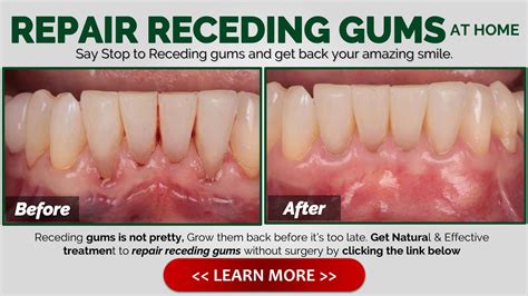 Repair Receding Gums At Home By Jeremy Mcdonald Issuu