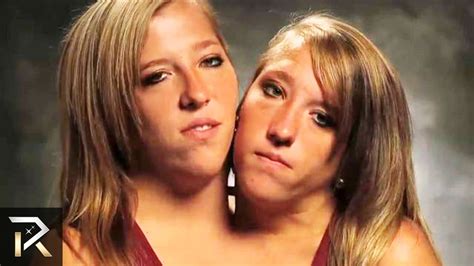 The Most Amazing Conjoined Twins Youtube