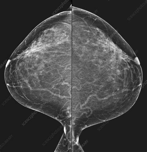 Normal Fibroglandular Densities Mammogram Stock Image C0393390