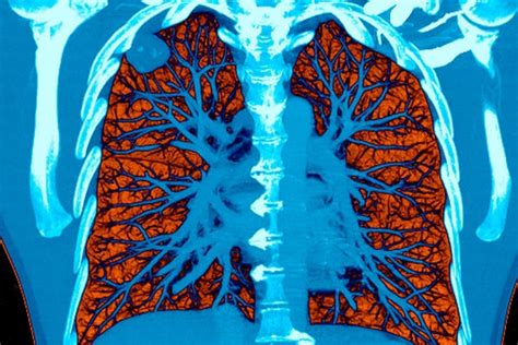 Widespread Lung Cancer Disparities Highlighted In American Lung