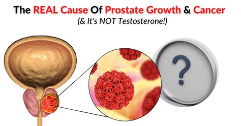 The Real Cause Of Prostate Growth Cancer Dr Sam Robbins