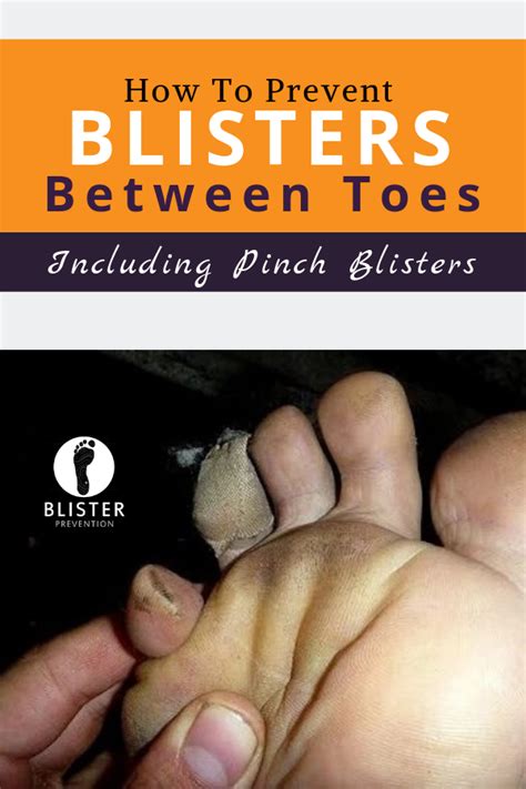 How To Prevent Blisters Between Toes And Pinch Blisters Blister