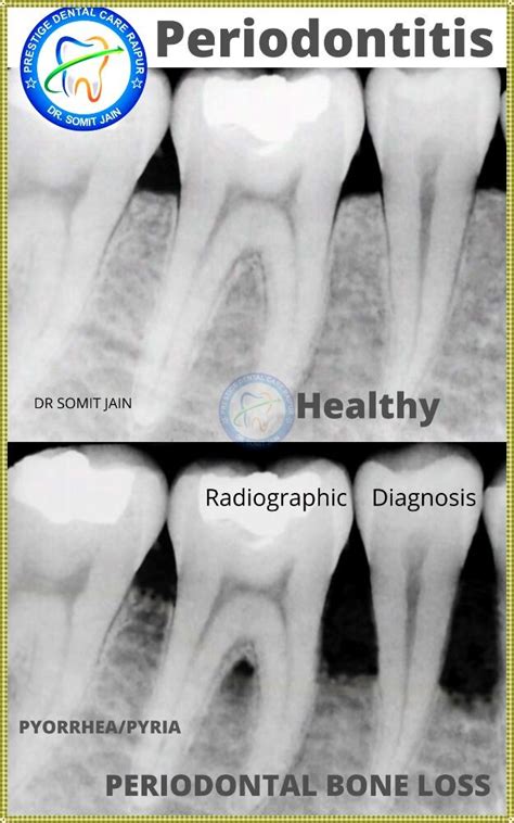 Maybe you would like to learn more about one of these? periodontal disease Archives - Prestige Dental Care