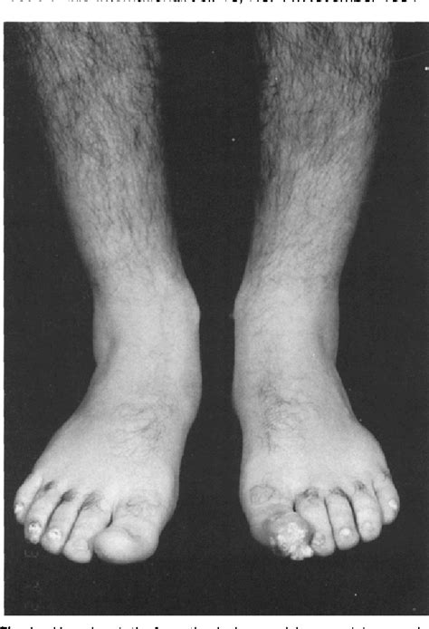 Figure 1 From An Adult With Juvenile Hyaline Fibromatosis Of The Foot