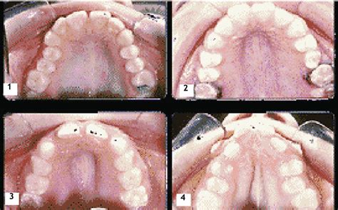 Palatal Arch Of Turner Syndrome 1 Normal 2 Mild 3 Moderate