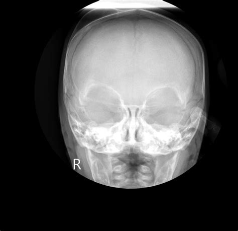 Cephalohematoma Image