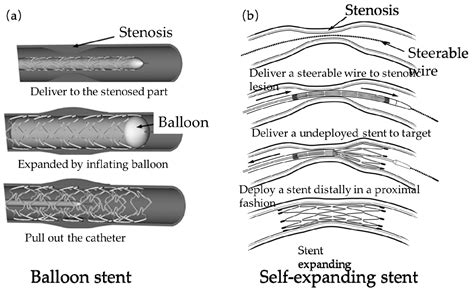 Micromachines Free Full Text Structural Design Of Vascular Stents
