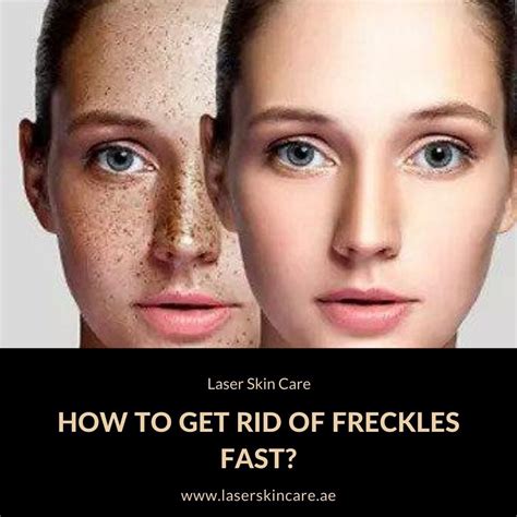 How To Get Rid Of Freckles Fast Laser Skin Care Getting Rid Of
