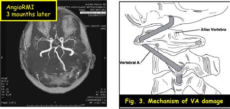 Figure From Vertebral Artery Dissection After Cervical Manipulation