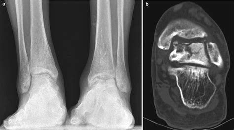 Osteonecrosis Of The Talus Radiology Key