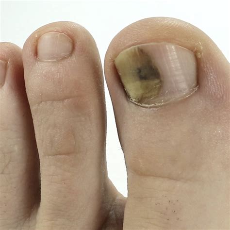 Melanoma Brown Spot On Toenail What Are The Different Types Of