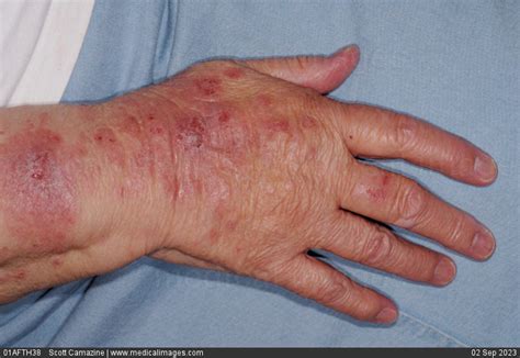 Stock Image Skin Lesions Of Dermatitis Herpetiformis Dh Also Called