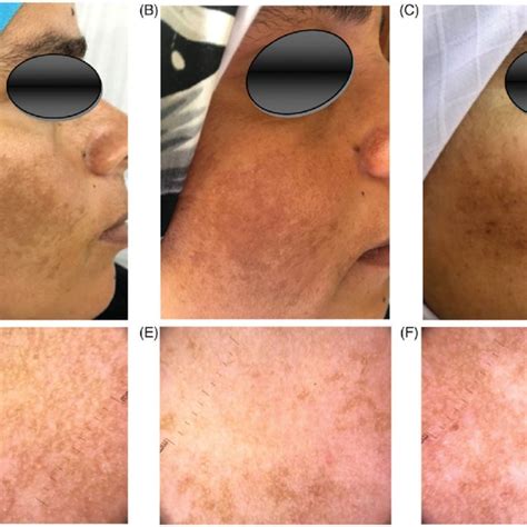 A Clinical Picture Of Dermal Melasma M Masi Before Treatment ¼ 324