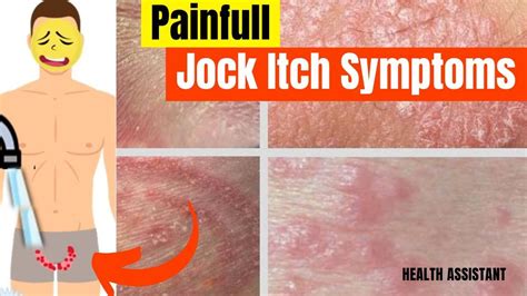 Jock Itch Symptoms Tinea Cruris Symptoms Jock Itch Bumps Severe