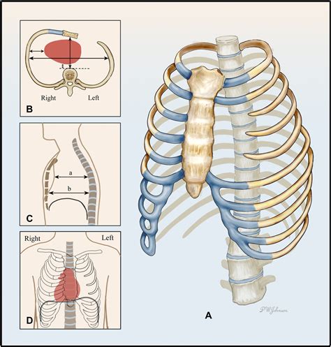 Figure 7 From Thoracic Defects Cleft Sternum And Poland Syndrome