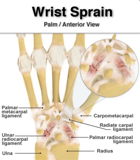 Sprained Wrist Symptoms And Treatments Grow Health