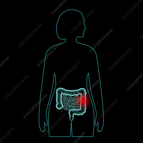 Intestine Disease Illustration Stock Image F0351883 Science