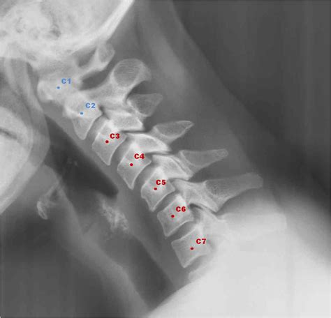 Template Matching Approaches Applied To Vertebra Detection In 2023