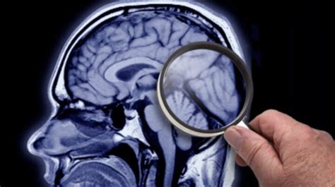 Higher Levels Of Vitamin D In Brain Tissue Could Ensure Better