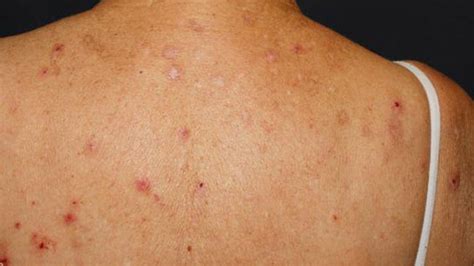 Itchy Rash Skin Anemia Symptoms Symptoms Of Disease Images