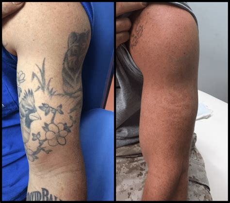 Tattoo Removal Facilities That Give Service Guarantee Anniversary