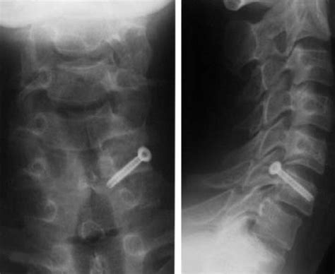 Cervical Lateral Mass Fracture Separation Spine Orthobullets