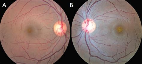 Retina Today Making A Diagnosis Unilateral Acute Idiopathic
