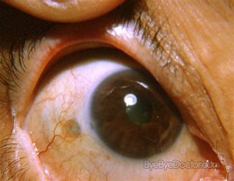 Scleritis Pictures Symptoms Causes Diagnosis Treatment Symptoms